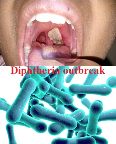 Diphtheria